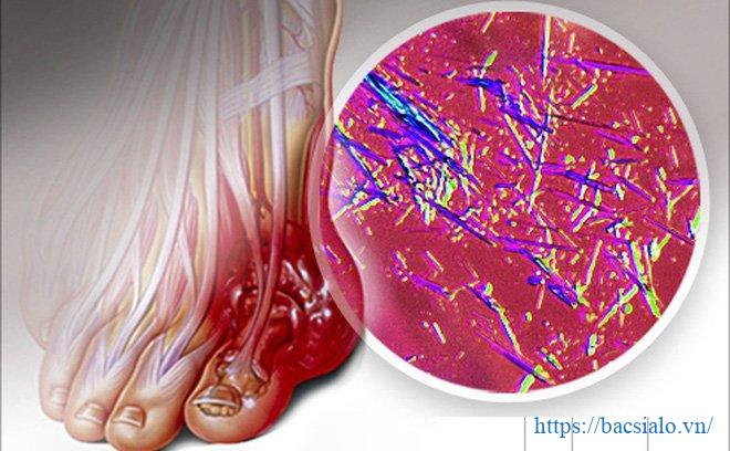Bệnh gout liên quan đến chỉ số acid uric trong máu