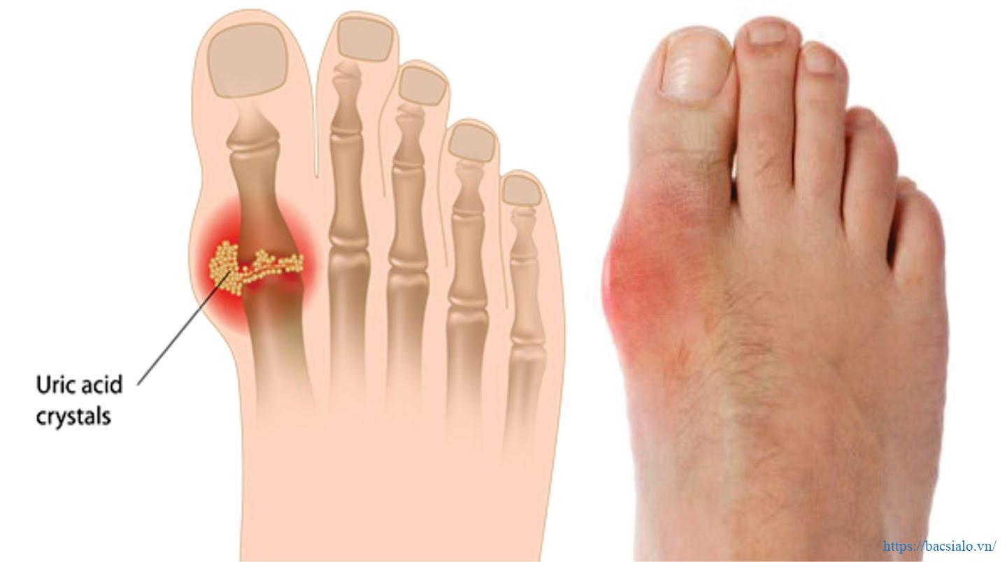 Dấu hiệu thường thấy của bệnh gout