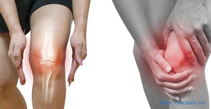 Sưng, nóng đỏ vùng khớp gối