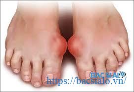 tai xuong 2 Triệu chứng lâm sàng của bệnh gout