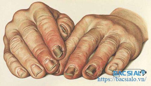 Bệnh thống phong là bệnh gì