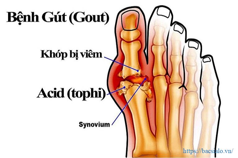 benh gut co lay khong