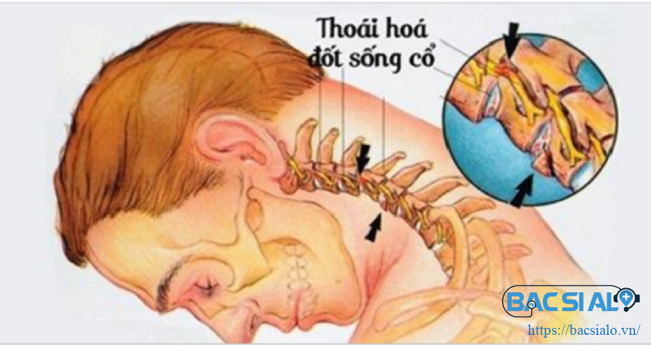 Thoái hóa đốt sống cổ