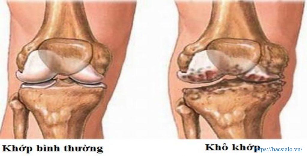 hinh anh so sanh giua khop kho va khop binh thuong