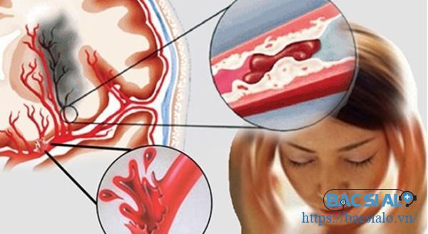 Bệnh tắc mạch máu não