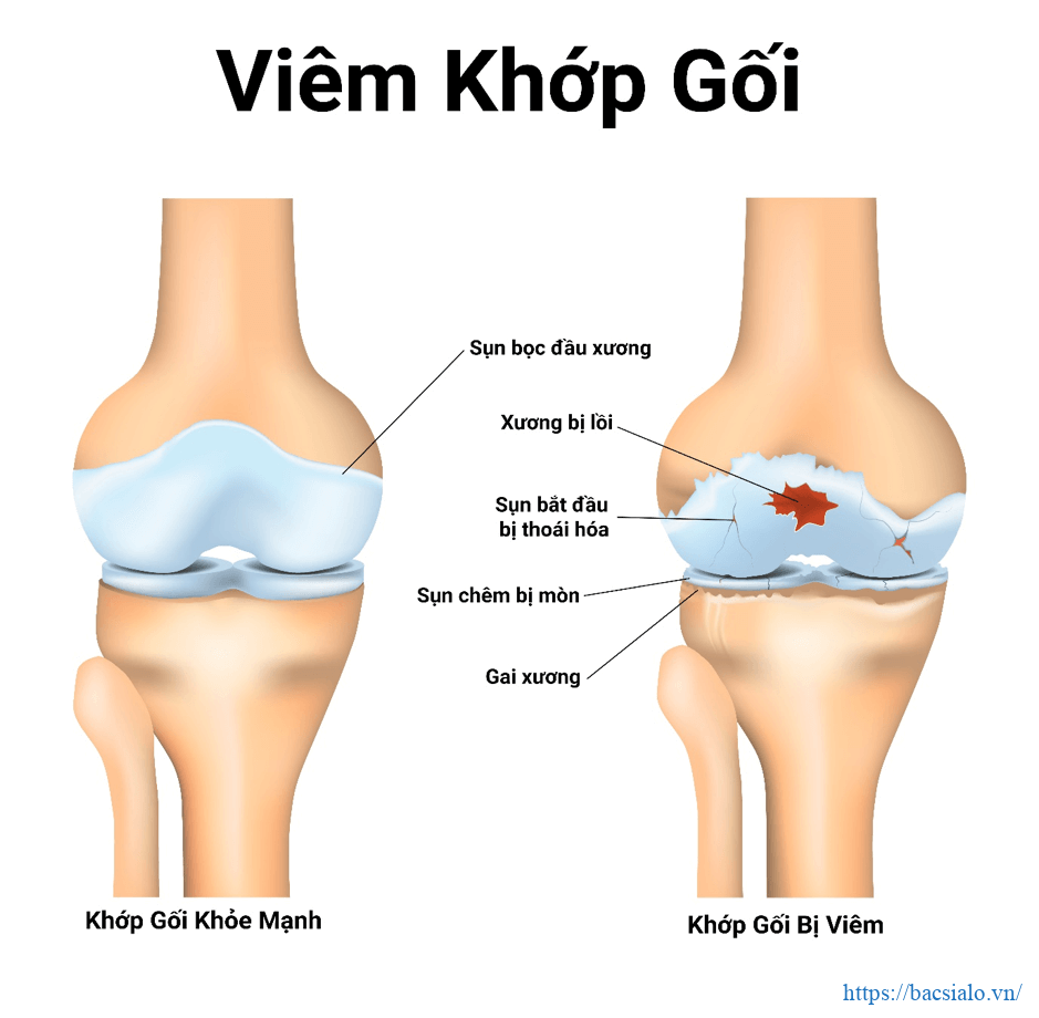 Dấu hiệu bệnh đau khớp, viêm khớp gối