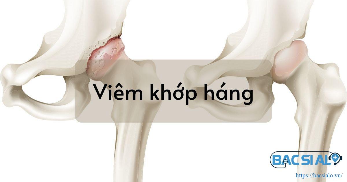 Viêm khớp háng