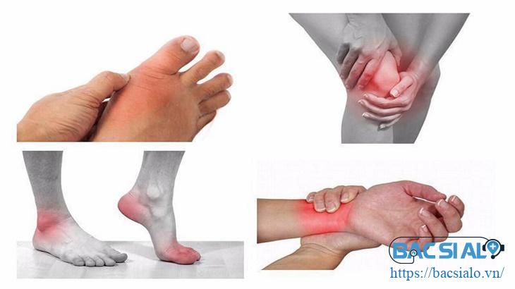viem khop man tinh trieu chung 1 Các vị trí khớp bị viêm, đau khi di chuyển