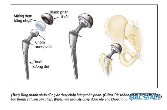 Phau thuat thay khop hang Phẫu thuật thay khớp khi cần thiết