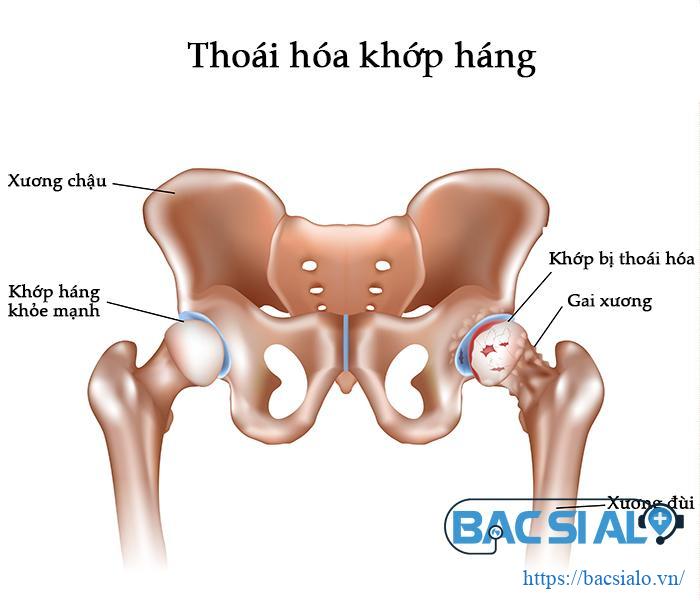 thoai hoa khop hang Thoái hóa khớp háng