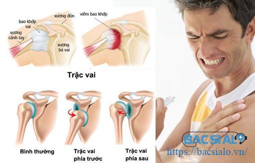 Chấn thương rách cơ vai Chấn thương rách cơ vai