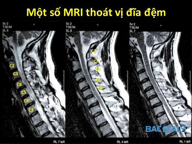 Hinh anh MRI Hinh anh MRI