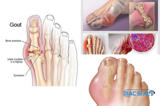 Tinh trang gout viem khop Vị trí của bênh gout