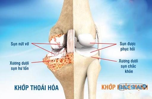 Tinh trang thoai hoa khop Tình trạng của thoái hóa khớp