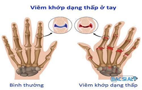 Dấu hiệu viêm khớp dạng thấp ở tay Dấu hiệu viêm khớp dạng thấp ở tay