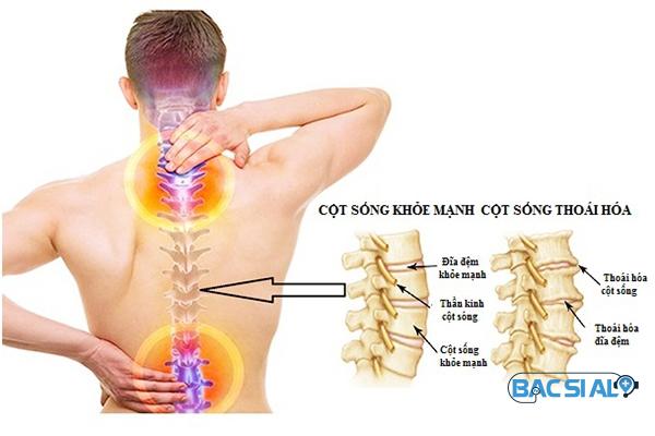 dau hieu thoai hoa cot song dau hieu thoai hoa cot song