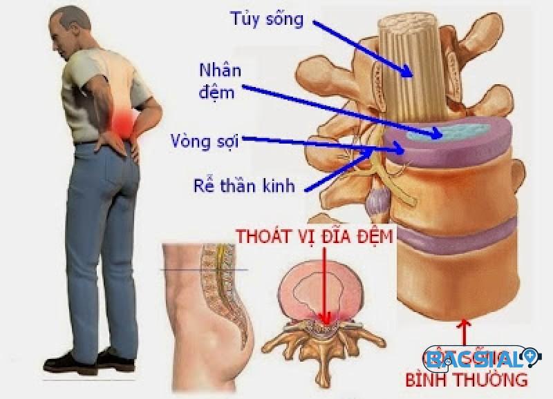 thoat vi dia dem la gi Thoát vị đĩa đệm cột sống thắt lưng
