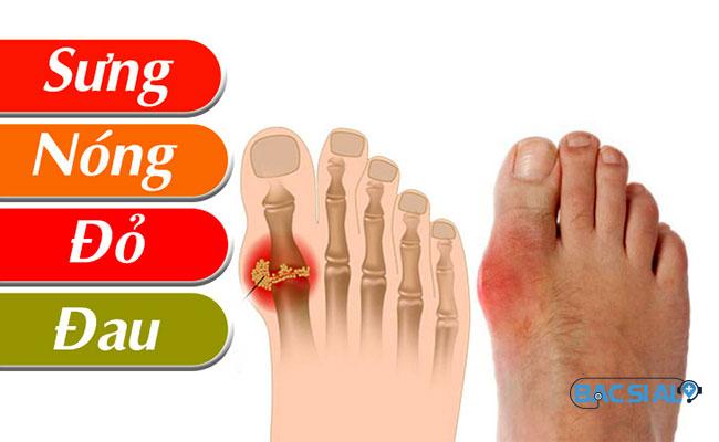 trieu chung co ban benh gut Triệu chứng cơ bản của bệnh gout